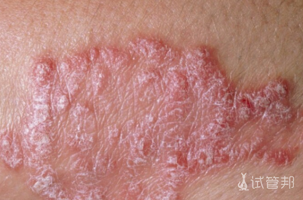 cccb2007d8bf7eff10446bfd7febe075.png 怎么治疗牛皮癣