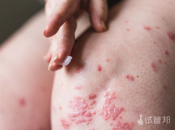 db95171b55dabb60f5a6c4769f3ba613.png 牛皮癣能根治吗