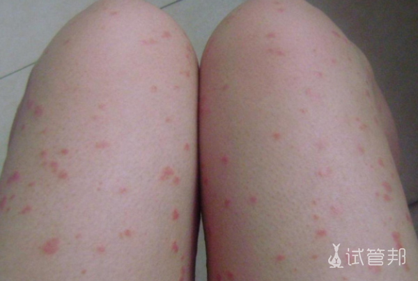 e8cf6a62f49996500167b6cd5eb18e5e.png 牛皮癣症状有哪些