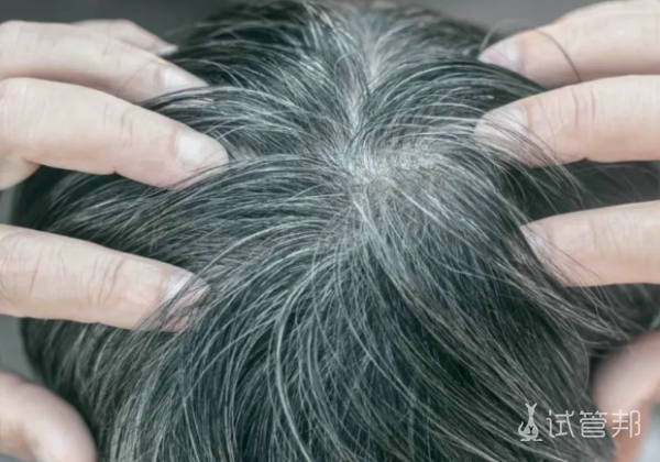 35d3f7dca24224435010fe9e10146072.png 少白头遗传的概率是多少