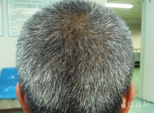 47392e0dcee54ba054960395bfb064ec.png 少白头如何治疗