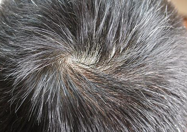 665855c88e793044de6d86257f1e56d5.png 少白头中医怎么调理