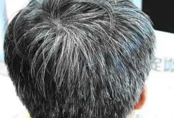 83f40e139a27be76d1891c4699f0a5ee.png 少白头的原因及治疗方法