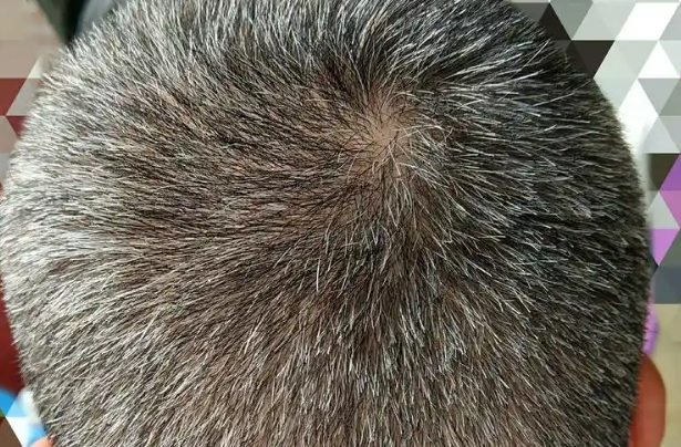 99f06a7cffb41c7e56f58b1668a6f2bd.png 少白头的原因有哪些