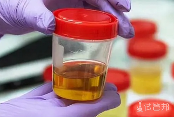 adc9f6f74f1adff5bcdd5bbeb899c466.png 尿酸碱度和尿酸的区别