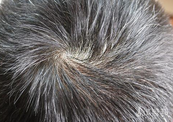 b45005ec84a162e27f81bcd75117e8c3.png 几岁能看出遗传少白头