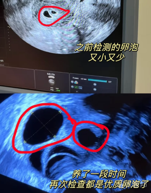 e0f6c109d59772cd99d8debe096f0a24.png 做试管前一定要养卵真的能前进一大步