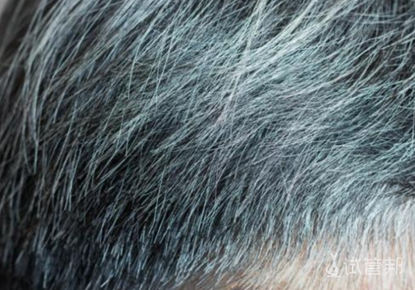 f2b5c381fbfa0f633e881237e05f0b28.png 遗传性少年白发能治好吗