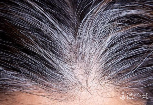 fd4a5e5c6a4a65d4e298096c7b42e987.png 少白头会遗传吗