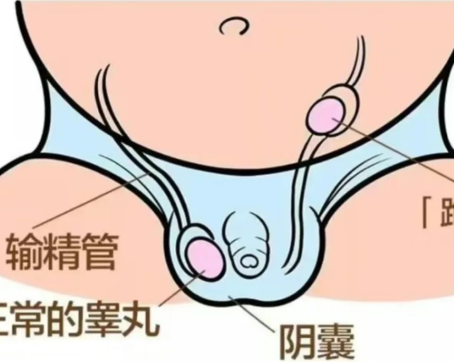 睾丸缺失一个结果孩子8岁才确诊做了手术