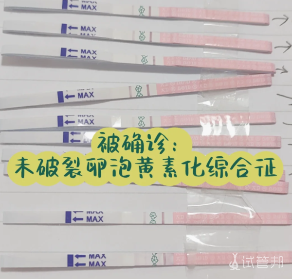 33633feb16445a284b027e6fcc9cbf54.png 被确诊为未破裂卵泡黄素化综合征