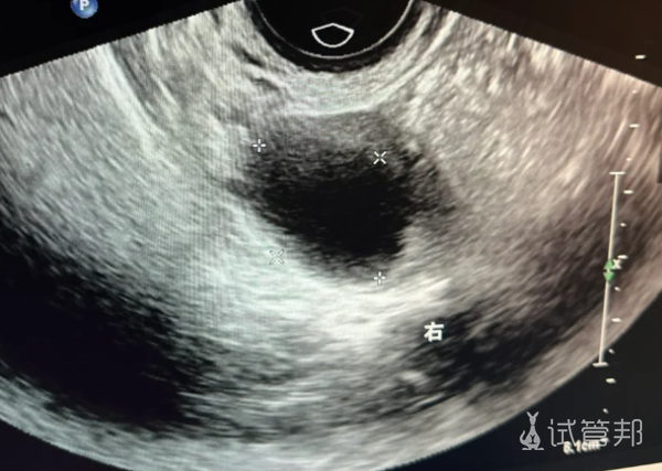 72437e356b77464fac4ffe38bec635a3.png 卵子没排出现卵泡黄素化了备孕失败