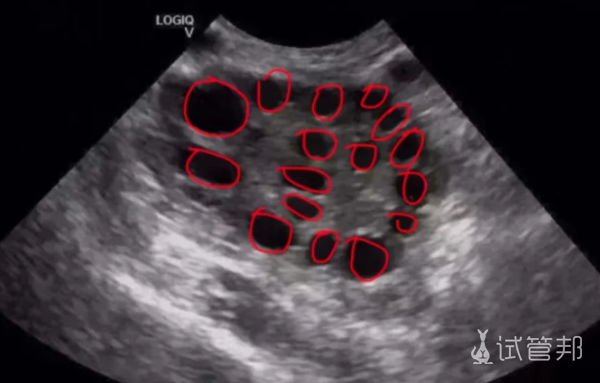 02aebe011a2f4030f6e1f5fad462baf1.png 感觉患有多囊的人越来越多了