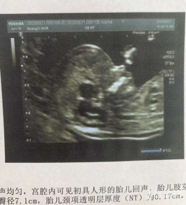 903bc2beb2448051ac7fe12b586d6941.png 确诊多囊流产后1个月又怀上了