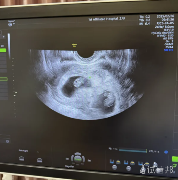 15986aa1c1a190c26db2307a4031450c.png 35岁做试管婴儿怀上双胞胎