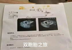 做试管婴儿顺利怀上双胞胎，终于如愿了