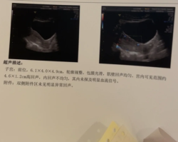 孕8周胎停，无奈进行药物流产
