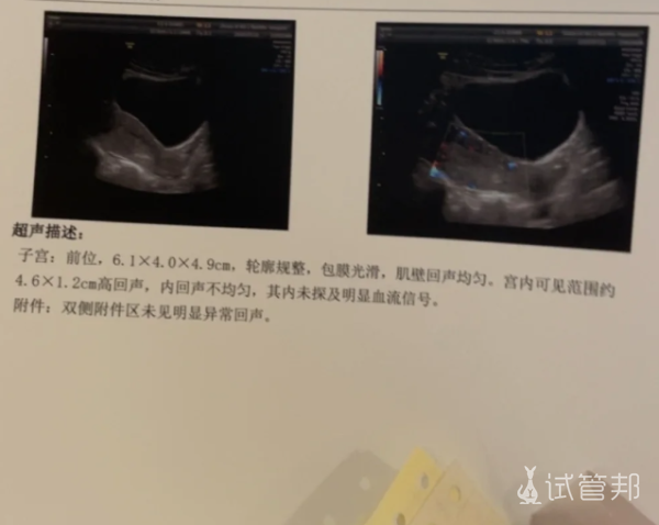 6fa66bd79cc5b7b7297fde8d77498787.png 孕8周胎停,无奈进行药物流产