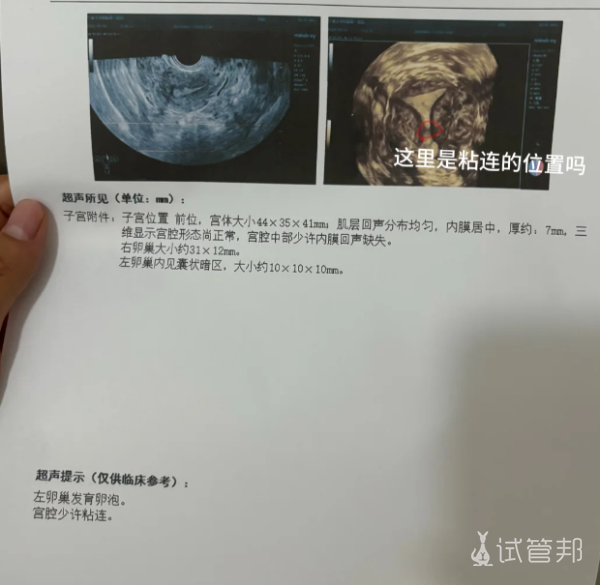 4ef349139ee2465dcec0d8547e6aec2e.png 宫腔粘连一定要做手术吗