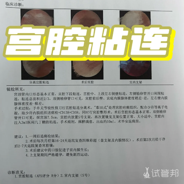 a5974cc58dba2603ce4827a4b989a980.png 宫腔粘连8分做了手术,希望能无缝衔接顺利移植