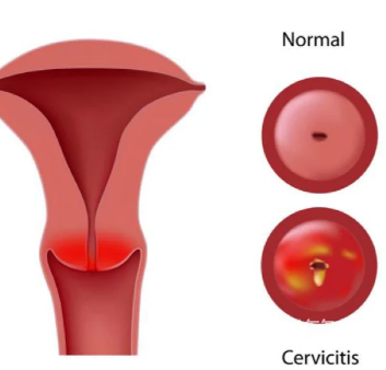 fe9f53dc3a472a3f807bf0020db82d55.png 宫颈肥大是怎么形成的