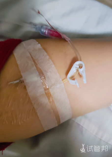 07ec7fd48dc1eae6a7b383bb06e811ba.png 输卵管复通手术全记录