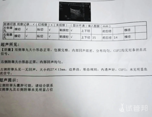 580890b63933e9f9e50bd0ab5e92dd88.png 附睾囊肿是怎么回事?原因分析