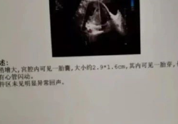 多囊宝妈试管成功，迎接新生命！