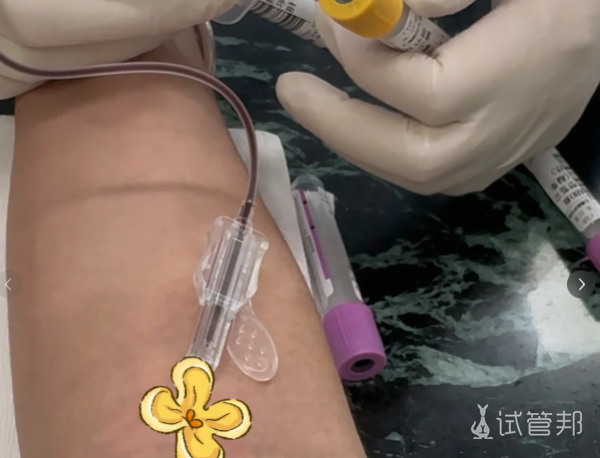 11527f2956933adda499c090774fb172.png 巧囊穿刺大揭秘生理盐水也能行
