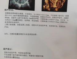 宫颈粘连手术是什么体验？