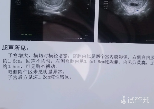 fd64cb6e4f4c9d48521f52007d3857fa.png 子宫畸形的5大隐藏信号你中招了吗