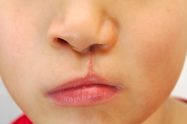 5be7e0d2e0b27149b0704b4a28be0b51.png 兔唇手术前需要做什么检查