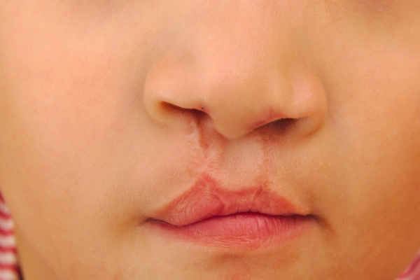 639b5ff069b9504aea837a755a8a9c2f.png 兔唇做nt能不能查出来