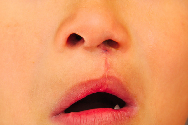 655c5f686ec64b046821ca4fb9c50d79.png 兔唇手术后怎么护理