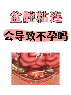 盆腔粘连真的会影响怀孕，一定要治疗