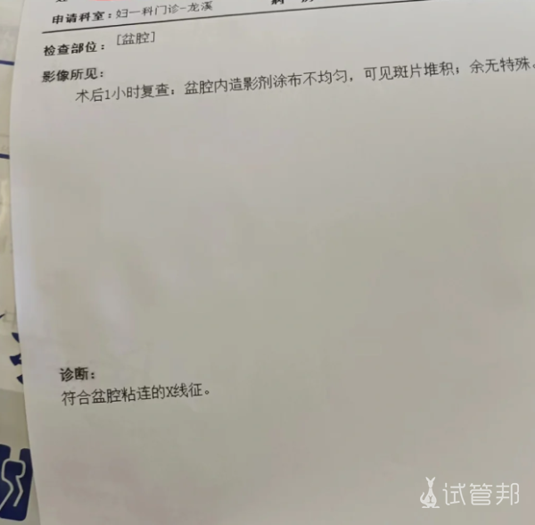 d458fa2dc7d3bb09e0fdd06248930c96.png 盆腔粘连影响怀孕吗