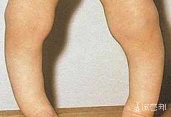 678332a0d4e41cfad39f2cfb39672843.png 佝偻病缺少什么元素