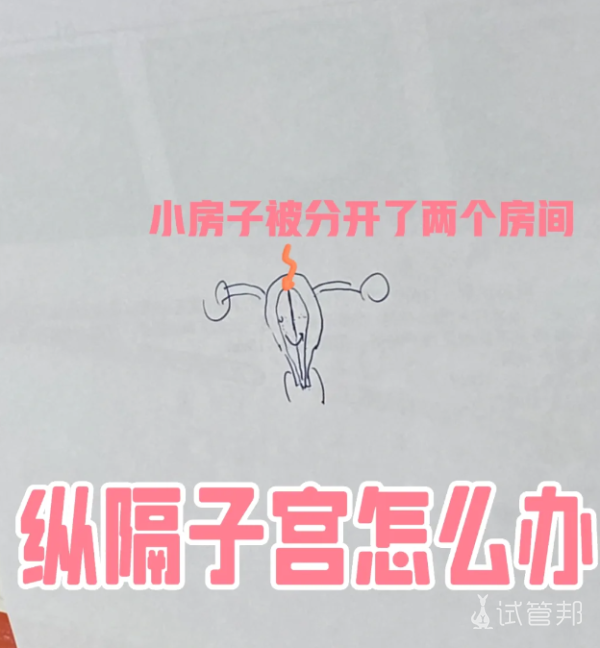 a3f7f602422a6576f1c9ca3e7d89131a.png 孕8周查出纵隔子宫,保胎中