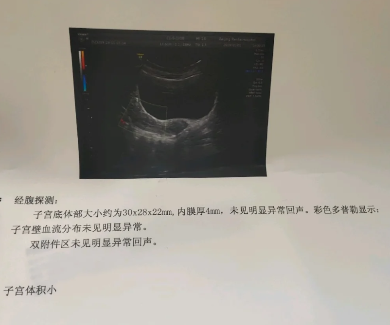 子宫小是怎么回事