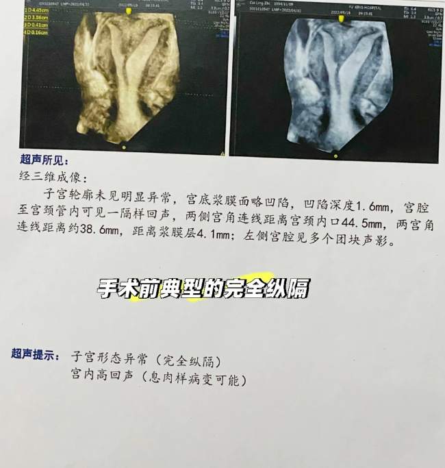 纵隔子宫是什么？能不能自然怀孕？亲身经历分享