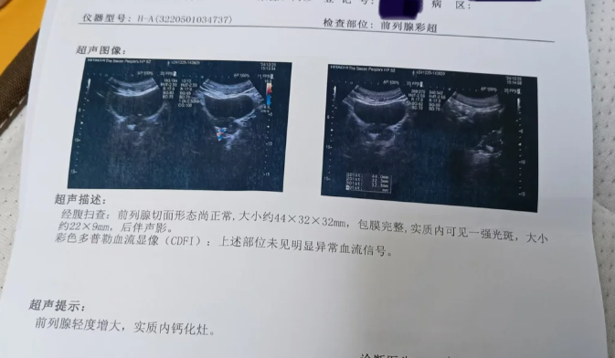 爸爸被诊断为前列腺钙化有医院或药推荐吗