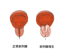 什么原因会导致前列腺增生出现？