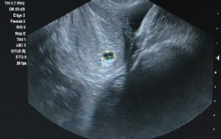 二代试管一次上岸！打工人试管请假攻略来了！