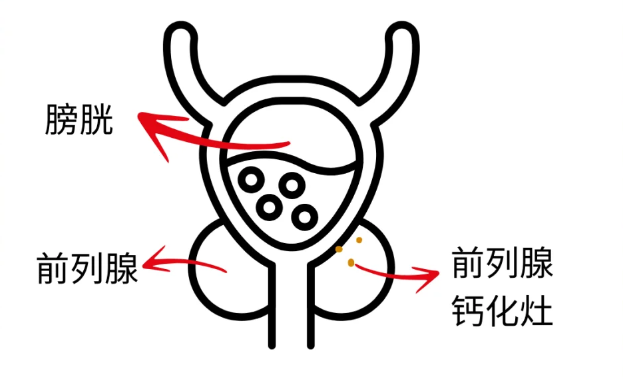 不懂前列腺钙化没事科普来了