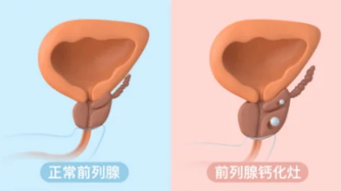 前列腺钙化是啥意思为什么会得啊