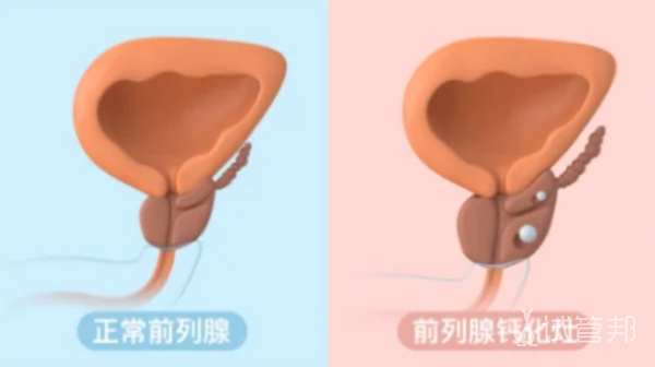 f70f073b102c3f8b76ede4112a91fb5f.png 前列腺钙化是啥意思为什么会得啊