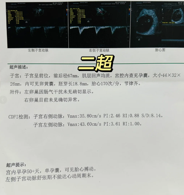 8299cba5dbd19804e920ad8a06a63fbb.png 试管移植后第39天,二超顺利通过