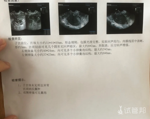 8530437777ed1fa0558e07bc640ffa52.png 查出宫颈纳氏囊肿该怎么办啊