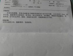 卵巢癌一发现就是晚期？