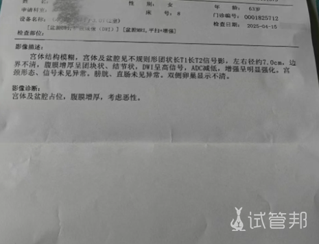 3fd2bc21e92652aa75c0fa24100eb35b.png 卵巢癌一发现就是晚期